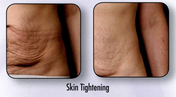Abdomen skin tightening — before and after