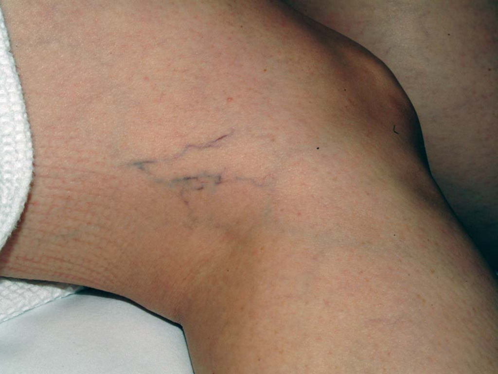 Leg capillaries before