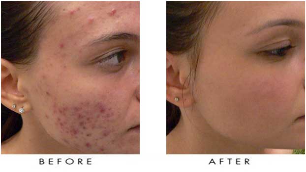 Acne treatment results