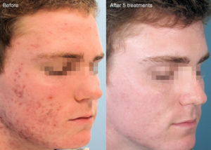 Clinical acne treatment