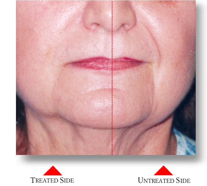 Lower face — treated side vs untreated side