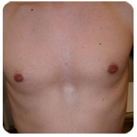Chest hair — after