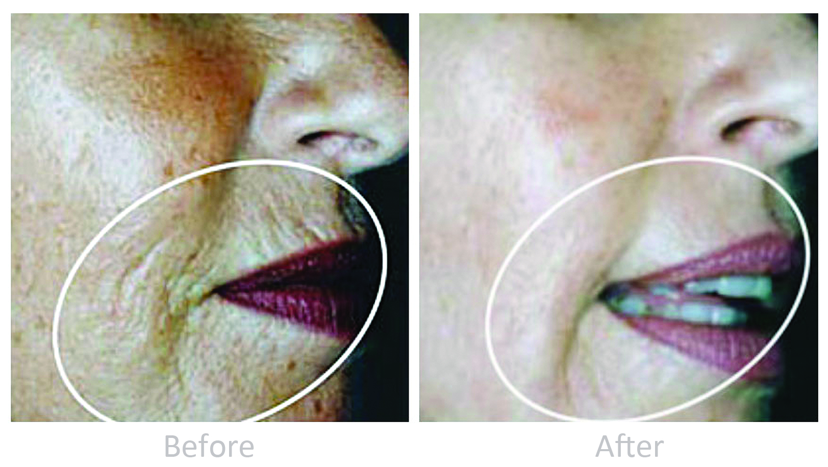 Perioral wrinkles — before and after