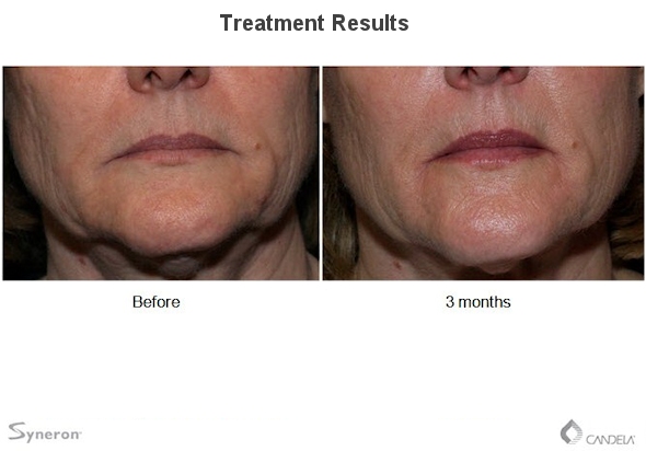 Laser Treatments