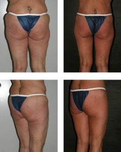 Body Treatments