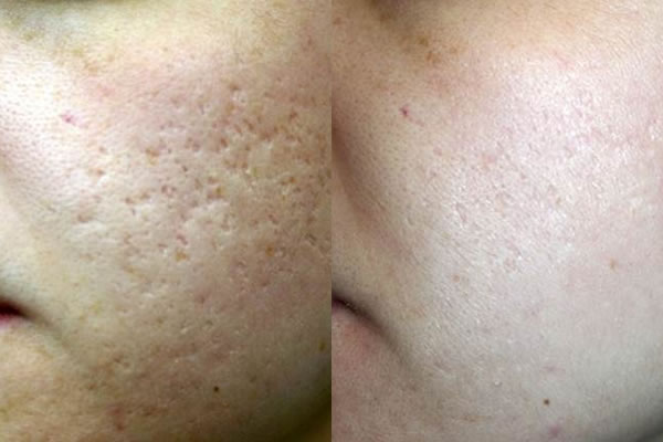 Acne scarring — before and after