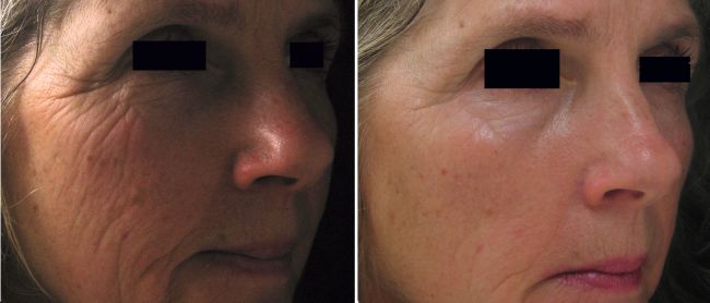 Skin Needling / Collagen Induction Therapy