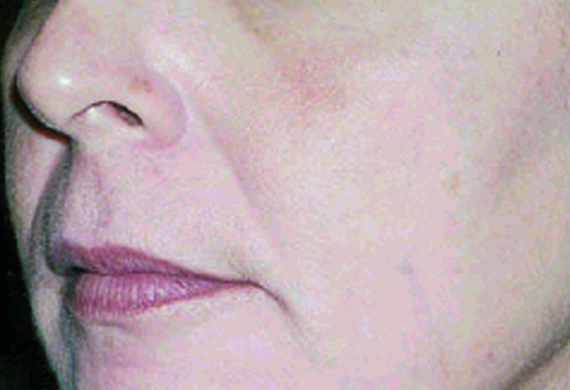 Patient 1 — after