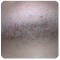 Facial hair — before