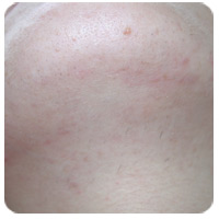 Laser Hair Removal