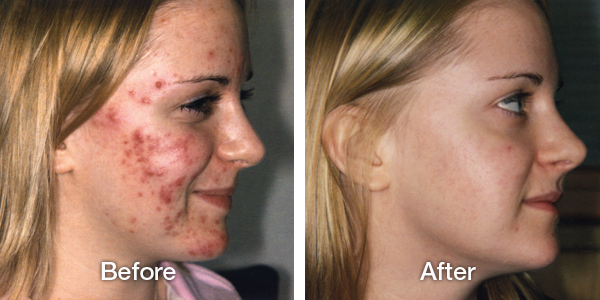 Acne treatment results