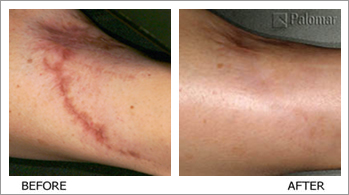 Scar softening — before and after