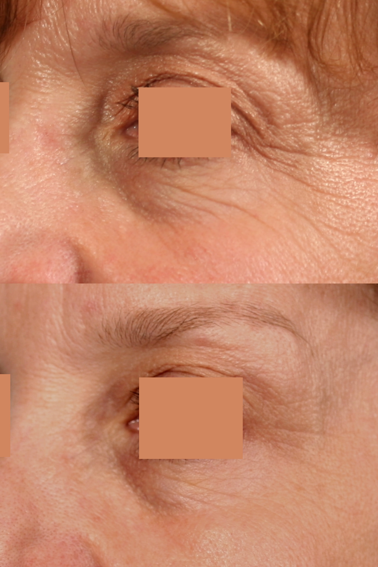 Smoother texture around the eye area