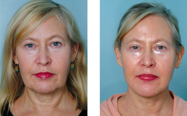Face and jawline — before and after