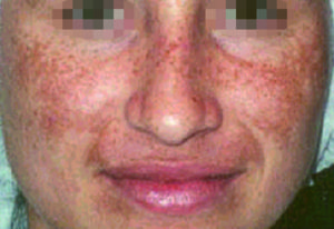 Before treatment