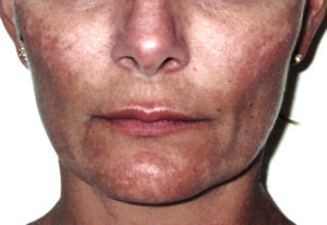 Before treatment