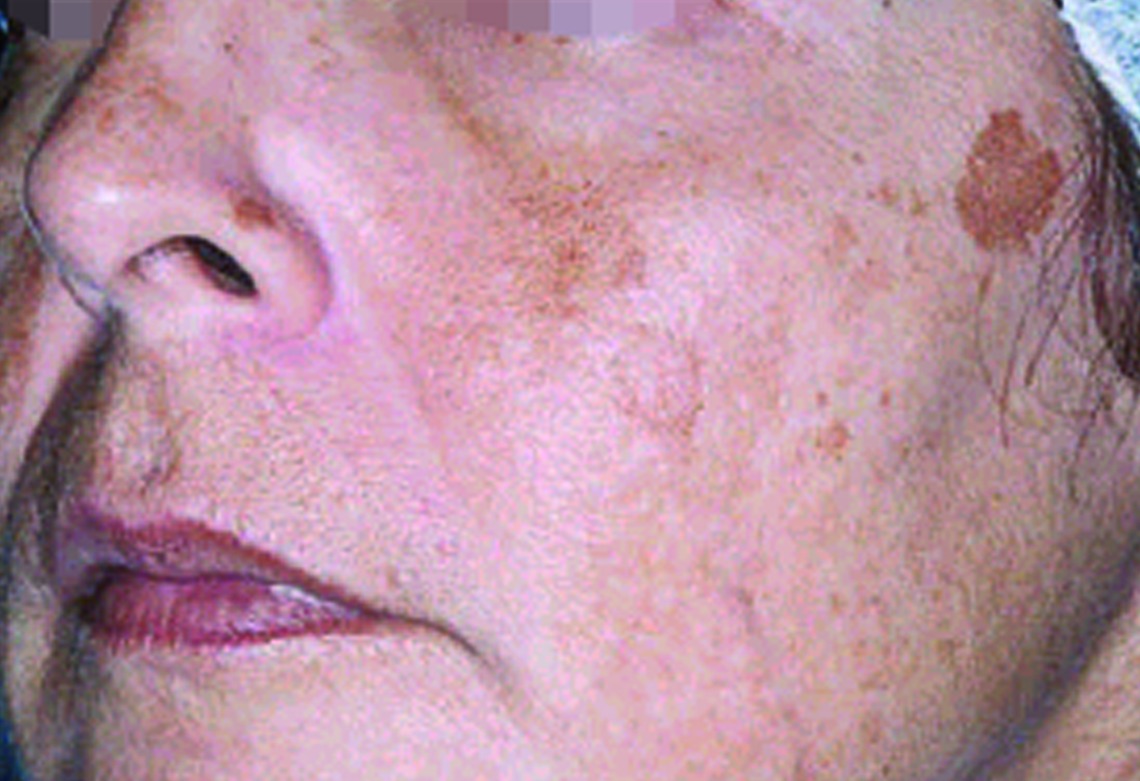 Patient 1 — before