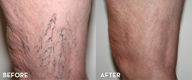 Leg veins — before and after