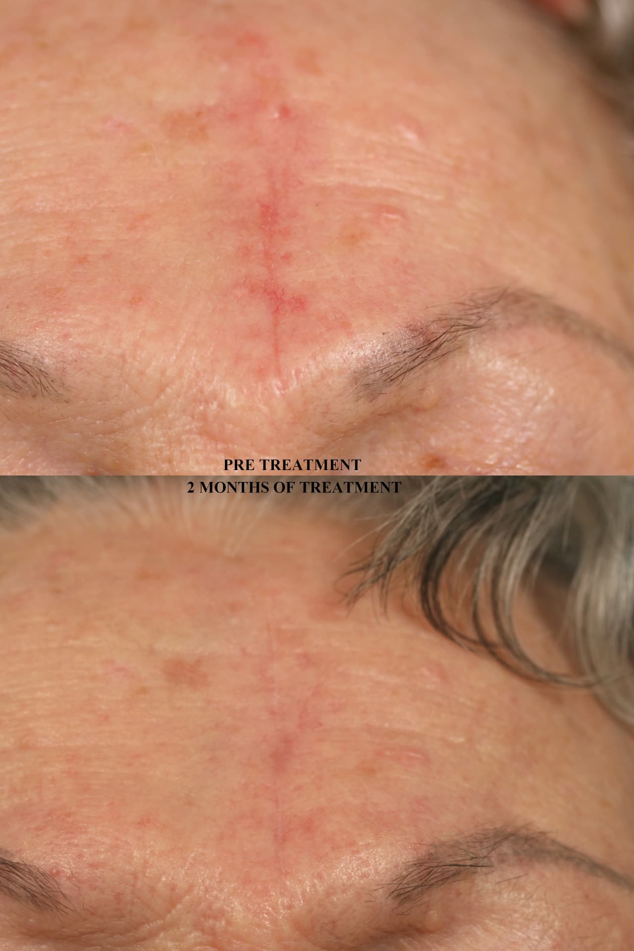 Pre treatment and after 2 months of treatment