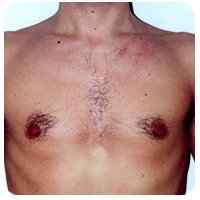 Chest hair — before