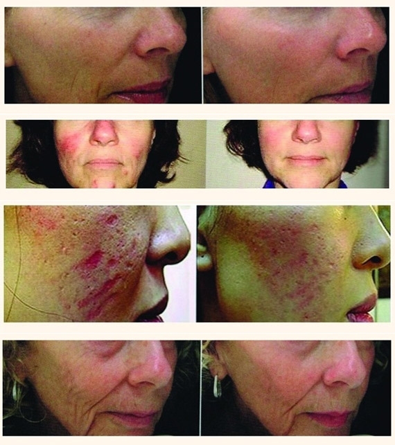 Collagen induction therapy — before and after series