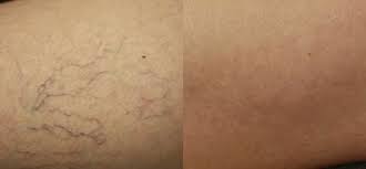 Telangiectasia — before and after