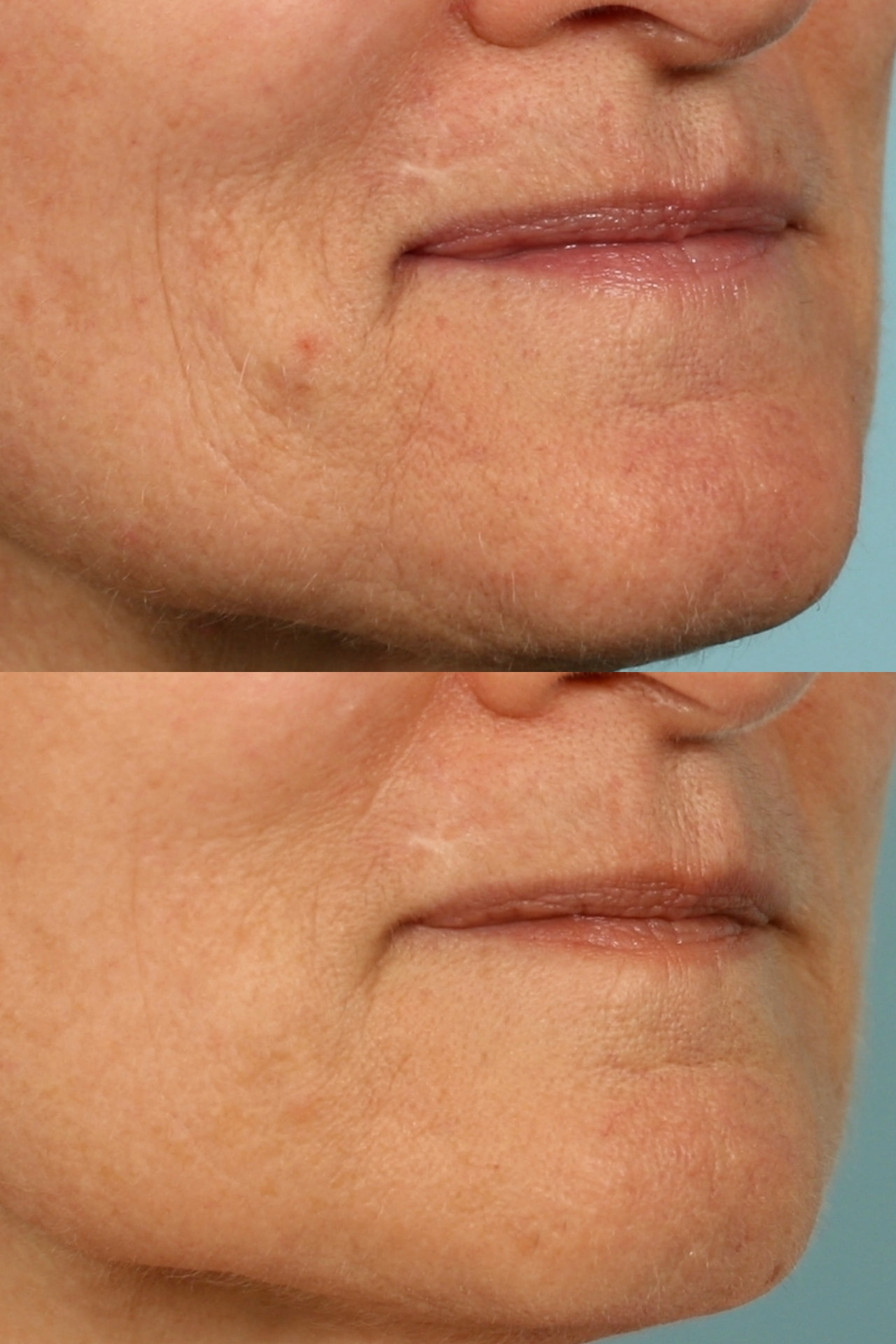 Softer lines around the mouth after a course of LED
