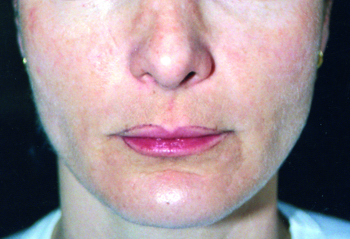 Patient 2 — after
