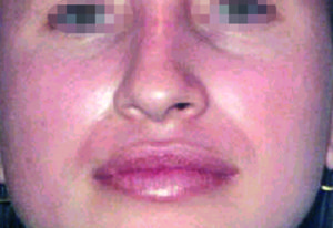 After treatment