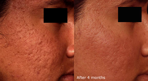 Acne scarring — before and after four months