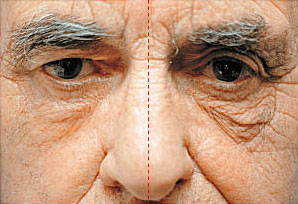 Eye area — treated side (left) vs untreated