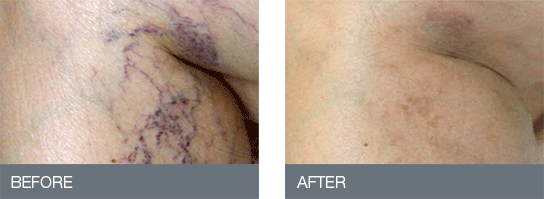 Leg veins — before and after