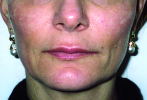 After treatment