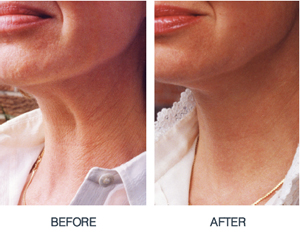 Neck firming — before and after